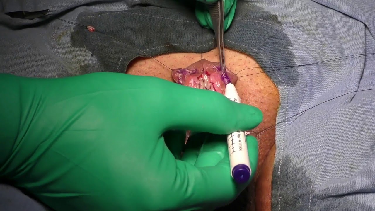 Treatment for Penile Torsion0
